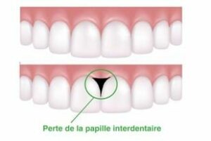 Le diagnostic - La gingivite, la parodontite, le détartrage