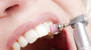 Le diagnostic - La gingivite, la parodontite, le détartrage
