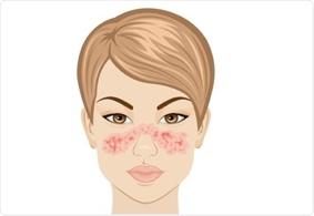 Le Lupus érythémateux disséminé - Les pathologies médicales et les influences de la cavité buccale