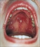 Le Lupus érythémateux disséminé - Les pathologies médicales et les influences de la cavité buccale