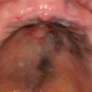 Le mélanome buccal - Les douleurs orales d’autres origines