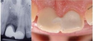 Le « Pont collé » - Perte des dents : comment y remédier ?