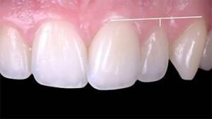 le rapport du collet des incisives avec la lèvre supérieure lors du sourire - Embellir son sourire ou une dent fragilisé