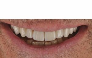 le rapport du collet des incisives avec la lèvre supérieure lors du sourire - Embellir son sourire ou une dent fragilisé