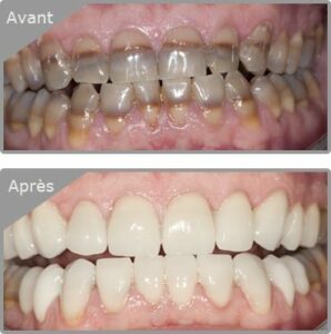 le rapport du collet des incisives avec la lèvre supérieure lors du sourire - Embellir son sourire ou une dent fragilisé