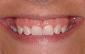 le rapport du collet des incisives avec la lèvre supérieure lors du sourire - Embellir son sourire ou une dent fragilisé