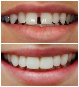 le rapport du collet des incisives avec la lèvre supérieure lors du sourire - Embellir son sourire ou une dent fragilisé