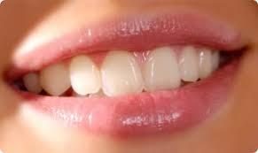 le rapport du collet des incisives avec la lèvre supérieure lors du sourire - Embellir son sourire ou une dent fragilisé