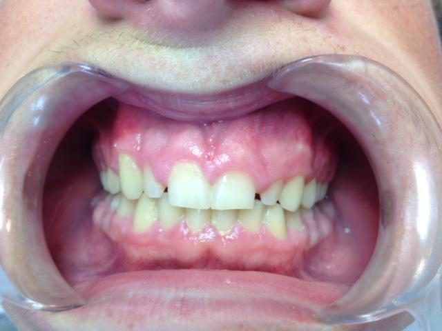 le rapport du collet des incisives avec la lèvre supérieure lors du sourire - Embellir son sourire ou une dent fragilisé