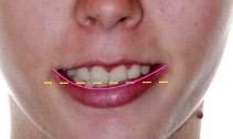 le rapport entre les dents et la lèvre inférieure lors du sourire - Embellir son sourire ou une dent fragilisée