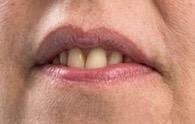 le rapport entre les dents et la lèvre inférieure lors du sourire - Embellir son sourire ou une dent fragilisée