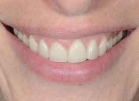 le rapport entre les dents et la lèvre inférieure lors du sourire - Embellir son sourire ou une dent fragilisée