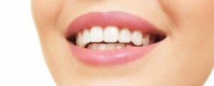 le rapport entre les dents et la lèvre inférieure lors du sourire - Embellir son sourire ou une dent fragilisée