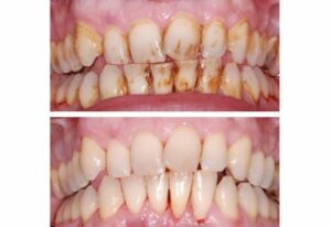 Les colorations externes (extrinsèques) - Embellir son sourire ou une dent fragilisée