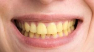 Les colorations internes (intrinsèques) - Embellir son sourire ou une dent fragilisée