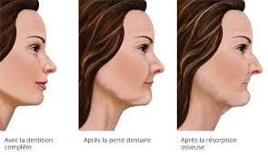 Les conséquences de la perte des dents