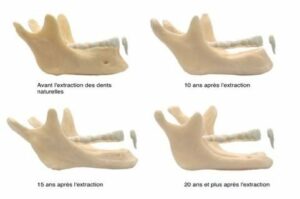 Les conséquences de la perte des dents