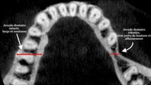 Les conséquences de la perte des dents