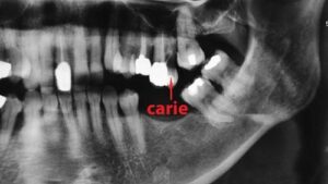 Les conséquences de la perte des dents