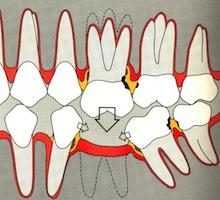 Les conséquences de la perte des dents