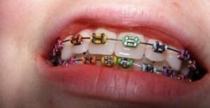 Les « coups de pouce » orthodontiques - La croissance harmonieuse du visage