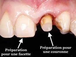 Les facettes pelliculaires - Embellir son sourire ou une dent fragilisée