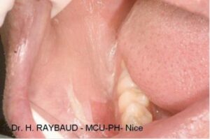 Les inflammations érosives : origine médicamenteuse / utilisation de bain de bouche - Les douleurs orales d’autres origi