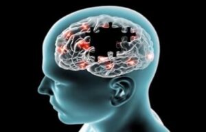 Les maladies neurodégénératives - Les pathologies médicales et les influences de la cavité buccale