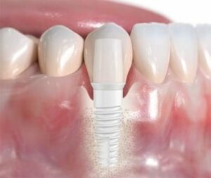 Les remplacement des dents perdues - Un peu d’histoire