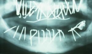 Les remplacement des dents perdues - Un peu d’histoire
