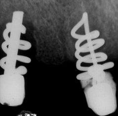 Les remplacement des dents perdues - Un peu d’histoire