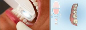 Les remplacement des dents perdues - Un peu d’histoire