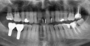 Les remplacement des dents perdues - Un peu d’histoire