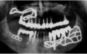 Les remplacement des dents perdues - Un peu d’histoire