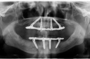 Les remplacement des dents perdues - Un peu d’histoire
