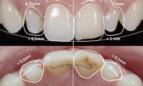 L’étude du sourire - Embellir son sourire ou une dent fragilisée
