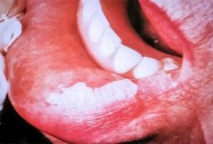 Leucoplasie - Les douleurs orales d’autres origines