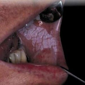 Leucoplasie - Les douleurs orales d’autres origines