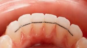 L’importance d’une contention à vie après un traitement orthodontique - La croissance harmonieuse du visage