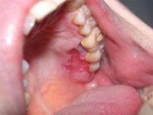 Lupus érythémateux - Les douleurs orales d’autres origines