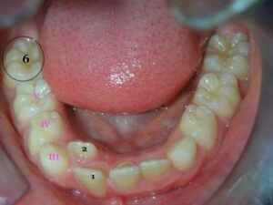 Mâchoire du bas Mâchoire du haut - Les premières dents
