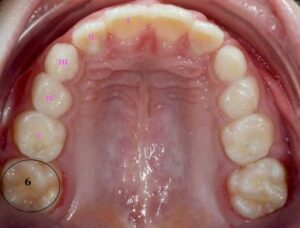 Mâchoire du bas Mâchoire du haut - Les premières dents