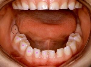 Mâchoire du bas Mâchoire du haut - Les premières dents