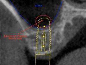 Origine infectieuse dépassement de pâte endodontique dépassement trop important de l’implant - Les douleurs orales d’aut
