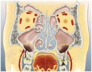 Origine infectieuse dépassement de pâte endodontique dépassement trop important de l’implant - Les douleurs orales d’aut