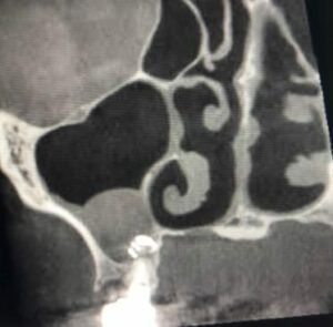Origine infectieuse dépassement de pâte endodontique dépassement trop important de l’implant - Les douleurs orales d’aut