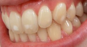 Paracelse -1537- - La composition des dentifrices actuels
