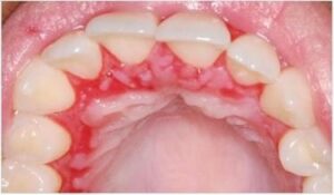 Pemphigus vulgaris - Les douleurs orales d’autres origines