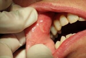 Pemphigus vulgaris - Les douleurs orales d’autres origines