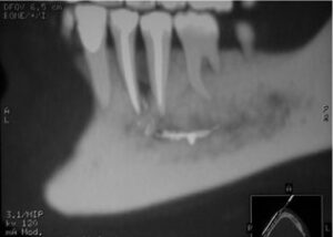 Perte de la sensibilité / picotements/ fourmillements/ brûlure/ douleur - Les complications après une intervention denta